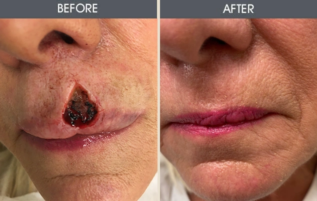 Real patient results in New York, NY Performed by Darrick E. Antell MD, FACS
