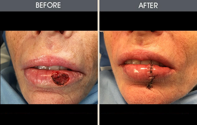 Real patient results in New York, NY Performed by Darrick E. Antell MD, FACS
