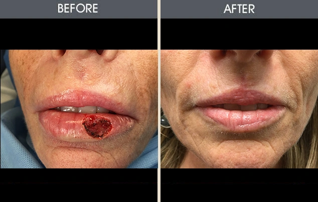 Real patient results in New York, NY Performed by Darrick E. Antell MD, FACS