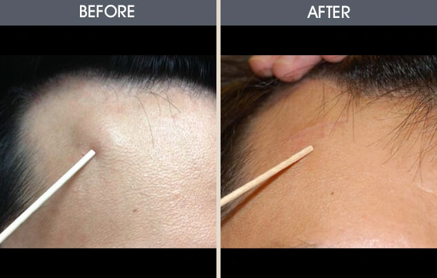Real patient results in New York, NY Performed by Darrick E. Antell MD, FACS