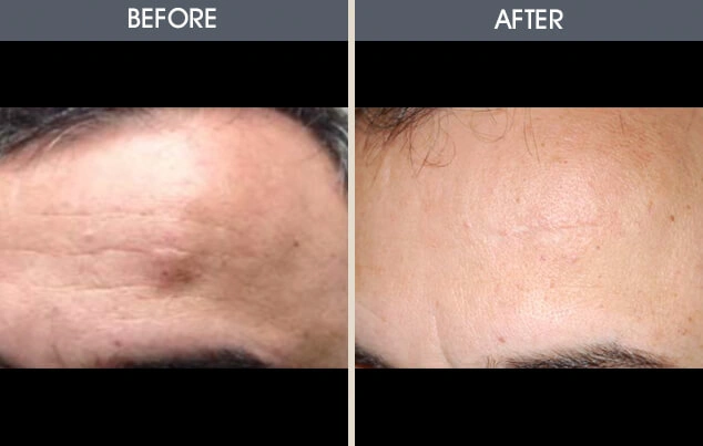 Real patient results in New York, NY Performed by Darrick E. Antell MD, FACS