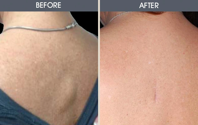 Real patient results in New York, NY Performed by Darrick E. Antell MD, FACS