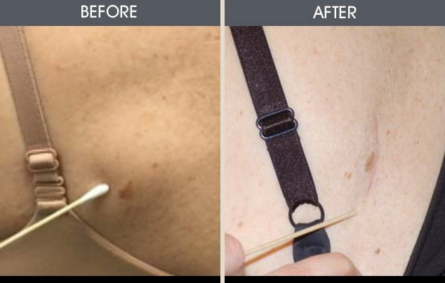 Real patient results in New York, NY Performed by Darrick E. Antell MD, FACS