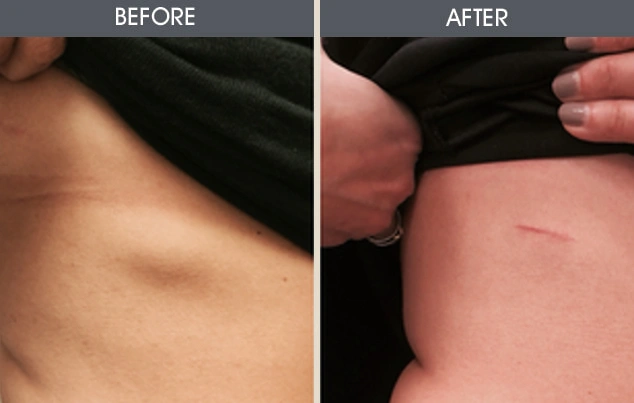 Real patient results in New York, NY Performed by Darrick E. Antell MD, FACS