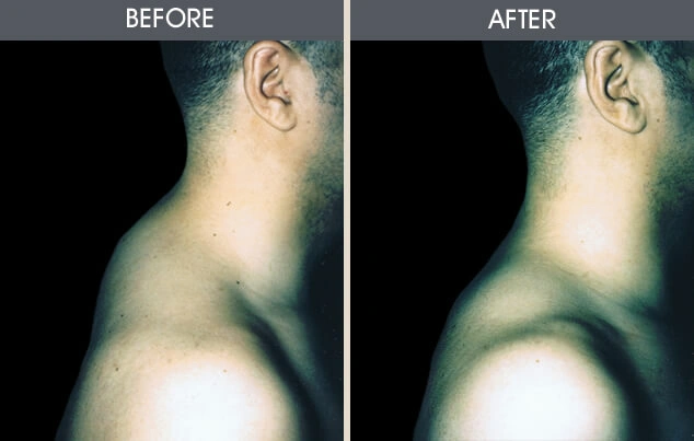 Real patient results in New York, NY Performed by Darrick E. Antell MD, FACS