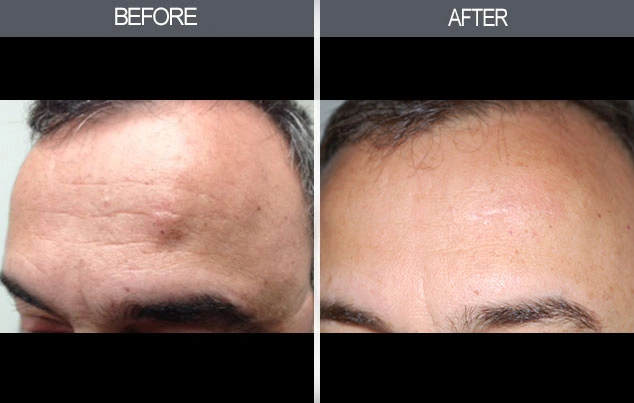 Real patient results in New York, NY Performed by Darrick E. Antell MD, FACS