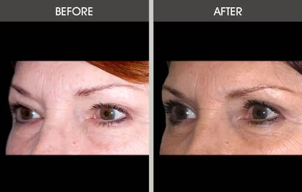 Real patient results in New York, NY Performed by Darrick E. Antell MD, FACS