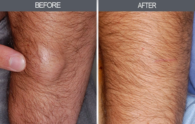 Real patient results in New York, NY Performed by Darrick E. Antell MD, FACS