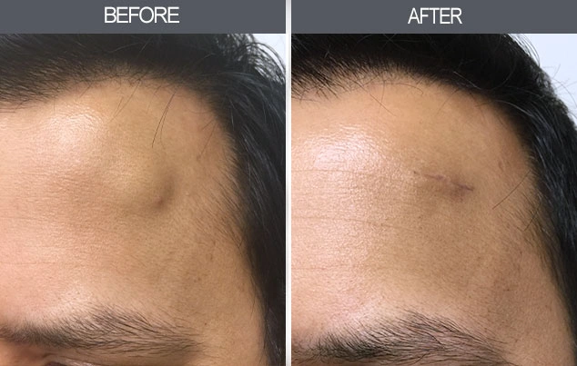 Real patient results in New York, NY Performed by Darrick E. Antell MD, FACS