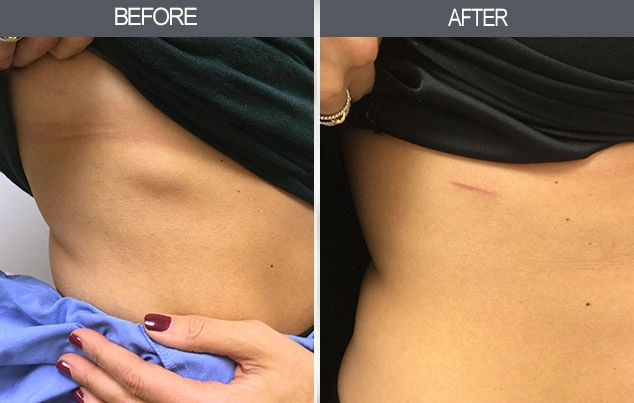 Real patient results in New York, NY Performed by Darrick E. Antell MD, FACS