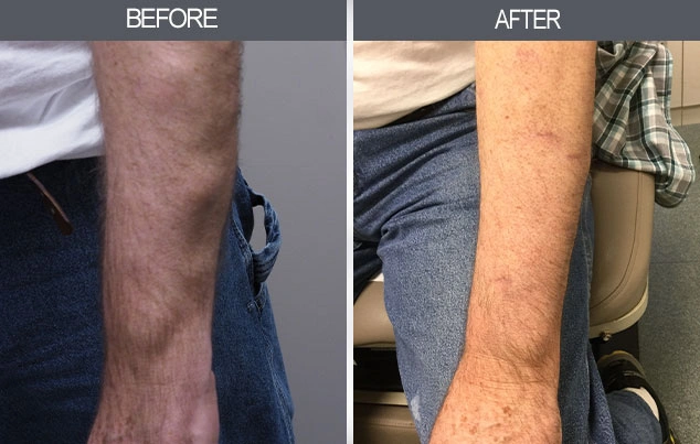 Real patient results in New York, NY Performed by Darrick E. Antell MD, FACS