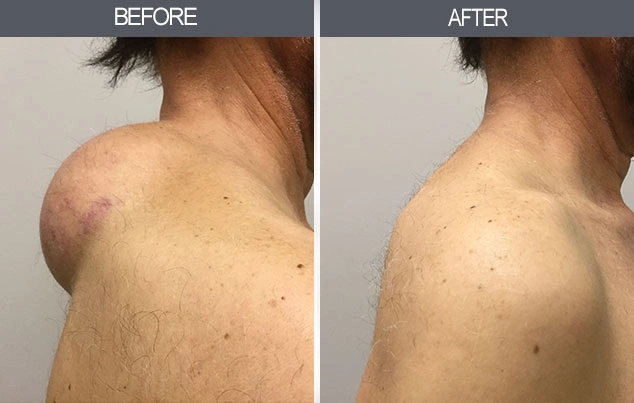 Real patient results in New York, NY Performed by Darrick E. Antell MD, FACS