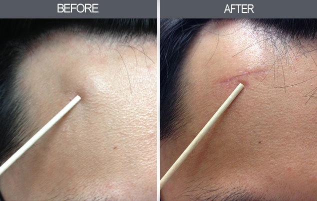 Real patient results in New York, NY Performed by Darrick E. Antell MD, FACS