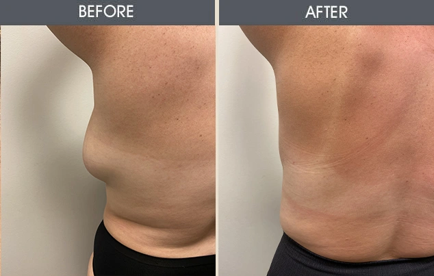 Real patient results in New York, NY Performed by Darrick E. Antell MD, FACS