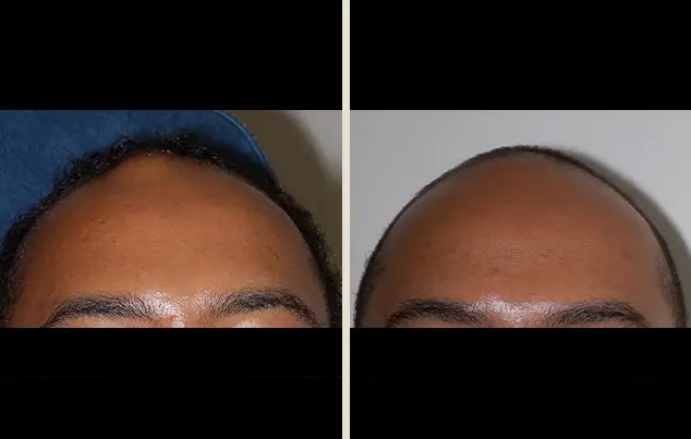 Real patient results in New York, NY Performed by Darrick E. Antell MD, FACS