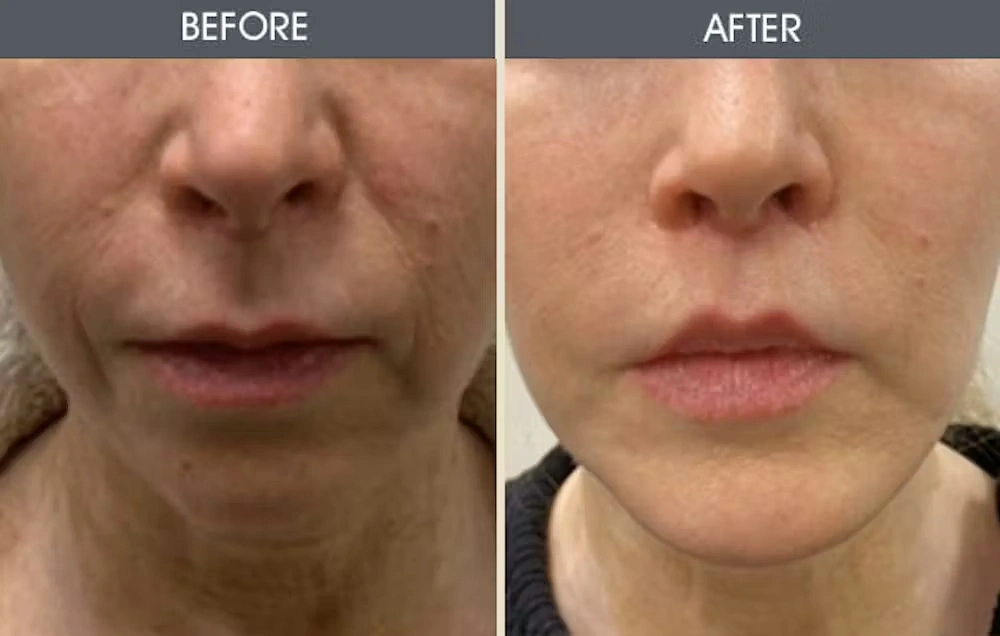 Real patient results in New York, NY Performed by Darrick E. Antell MD, FACS