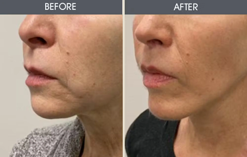 Real patient results in New York, NY Performed by Darrick E. Antell MD, FACS