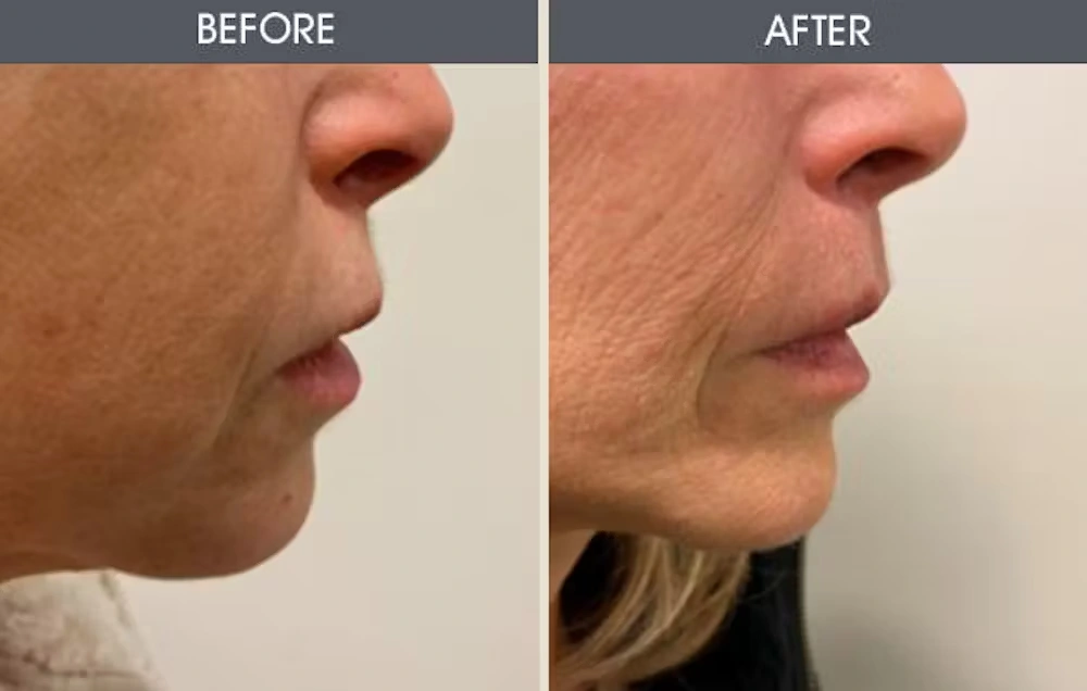 Real patient results in New York, NY Performed by Darrick E. Antell MD, FACS
