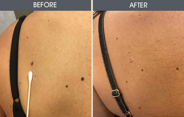 Real patient results in New York, NY Performed by Darrick E. Antell MD, FACS