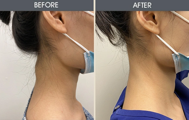 Real patient results in New York, NY Performed by Darrick E. Antell MD, FACS