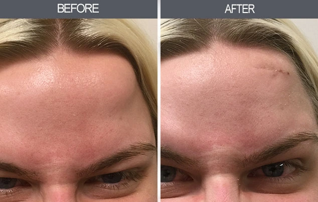 Real patient results in New York, NY Performed by Darrick E. Antell MD, FACS
