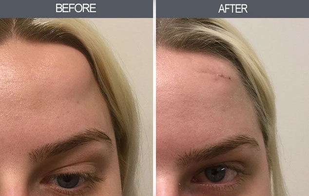 Real patient results in New York, NY Performed by Darrick E. Antell MD, FACS