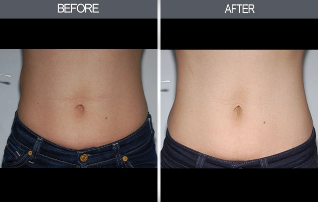Real patient results in New York, NY Performed by Darrick E. Antell MD, FACS