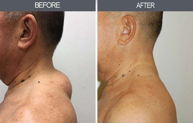 Real patient results in New York, NY Performed by Darrick E. Antell MD, FACS