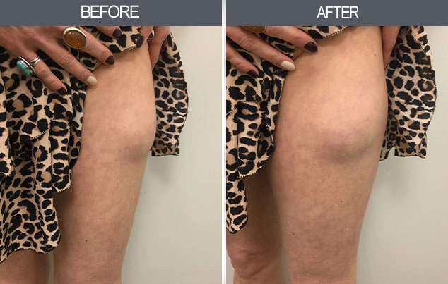 Real patient results in New York, NY Performed by Darrick E. Antell MD, FACS