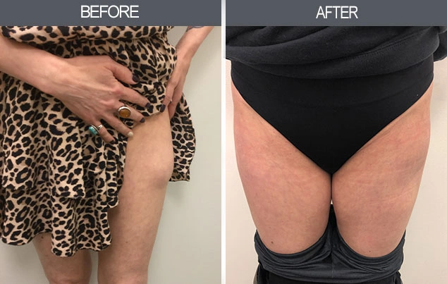 Real patient results in New York, NY Performed by Darrick E. Antell MD, FACS