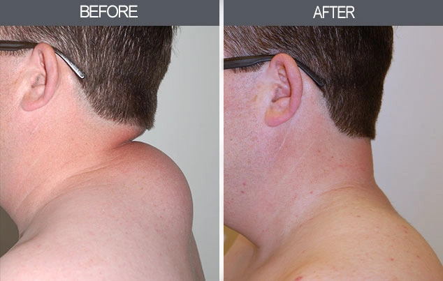 Real patient results in New York, NY Performed by Darrick E. Antell MD, FACS