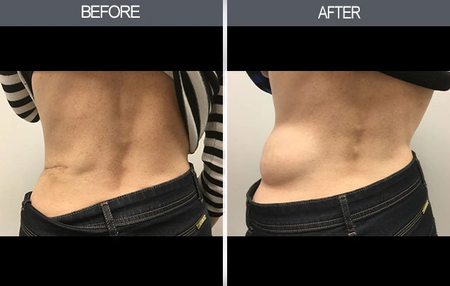 Real patient results in New York, NY Performed by Darrick E. Antell MD, FACS