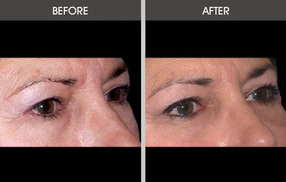 Real patient results in New York, NY Performed by Darrick E. Antell MD, FACS