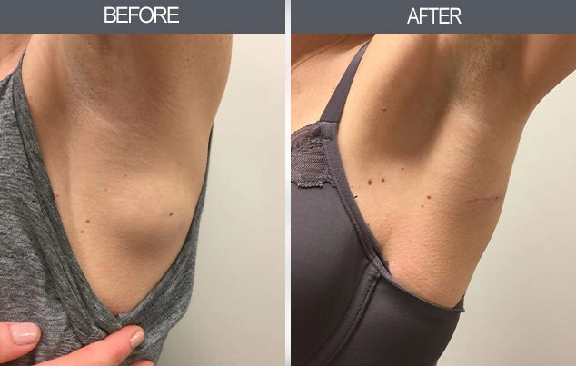 Real patient results in New York, NY Performed by Darrick E. Antell MD, FACS