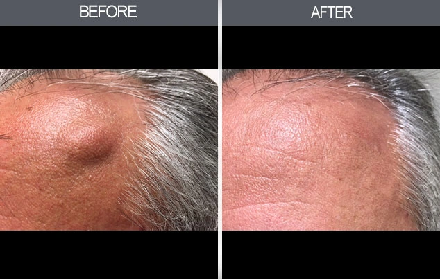Real patient results in New York, NY Performed by Darrick E. Antell MD, FACS