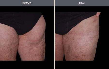 Real patient results in New York, NY Performed by Darrick E. Antell MD, FACS