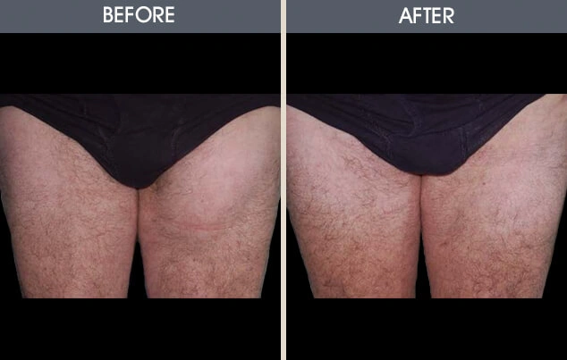 Real patient results in New York, NY Performed by Darrick E. Antell MD, FACS