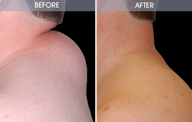 Real patient results in New York, NY Performed by Darrick E. Antell MD, FACS