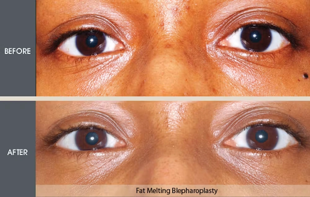 Real patient results in New York, NY Performed by Darrick E. Antell MD, FACS