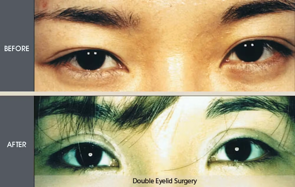 Real patient results in New York, NY Performed by Darrick E. Antell MD, FACS