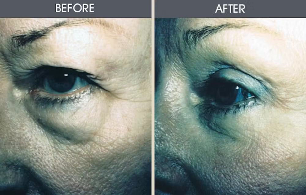 Real patient results in New York, NY Performed by Darrick E. Antell MD, FACS