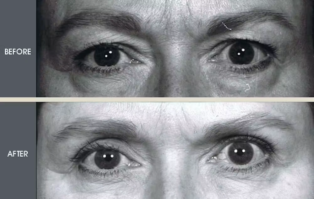 Real patient results in New York, NY Performed by Darrick E. Antell MD, FACS
