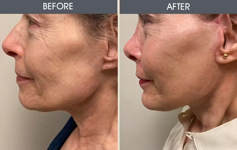 Real patient results in New York, NY Performed by Darrick E. Antell MD, FACS