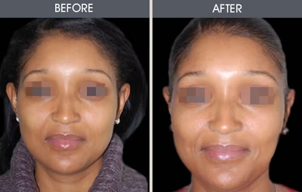 Real patient results in New York, NY Performed by Darrick E. Antell MD, FACS