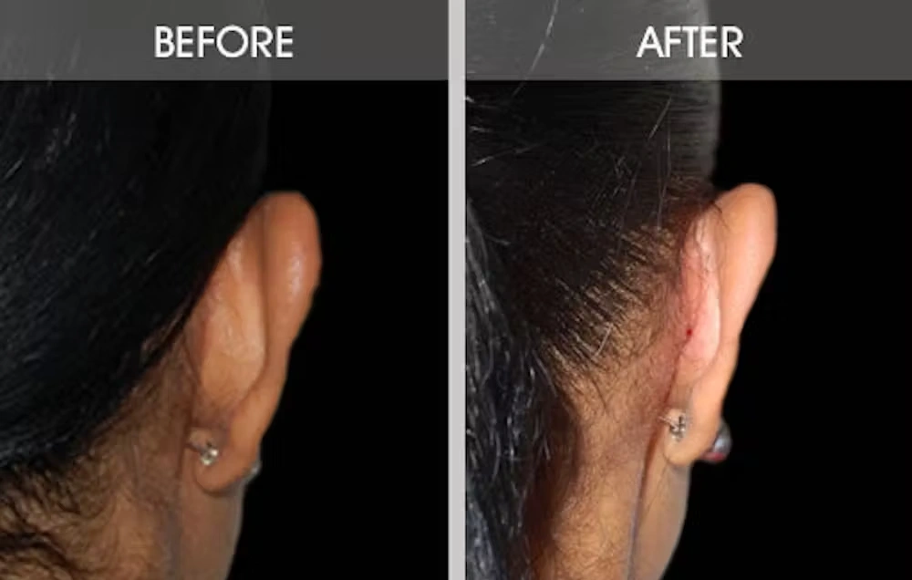 Real patient results in New York, NY Performed by Darrick E. Antell MD, FACS