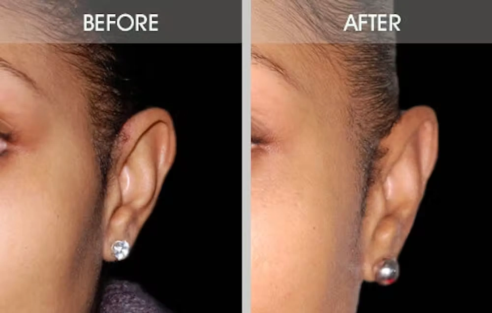 Real patient results in New York, NY Performed by Darrick E. Antell MD, FACS
