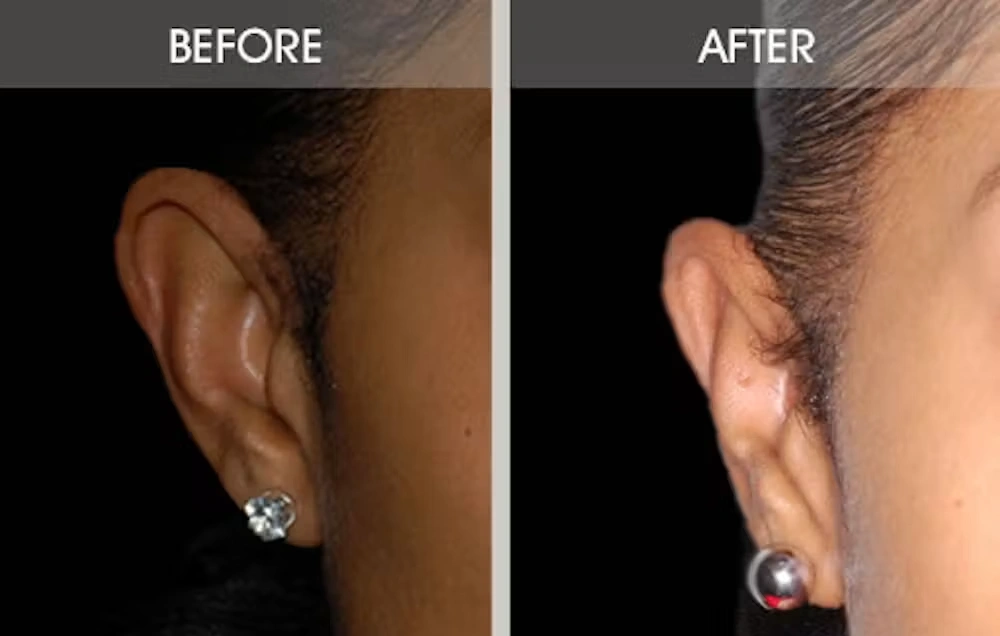 Real patient results in New York, NY Performed by Darrick E. Antell MD, FACS