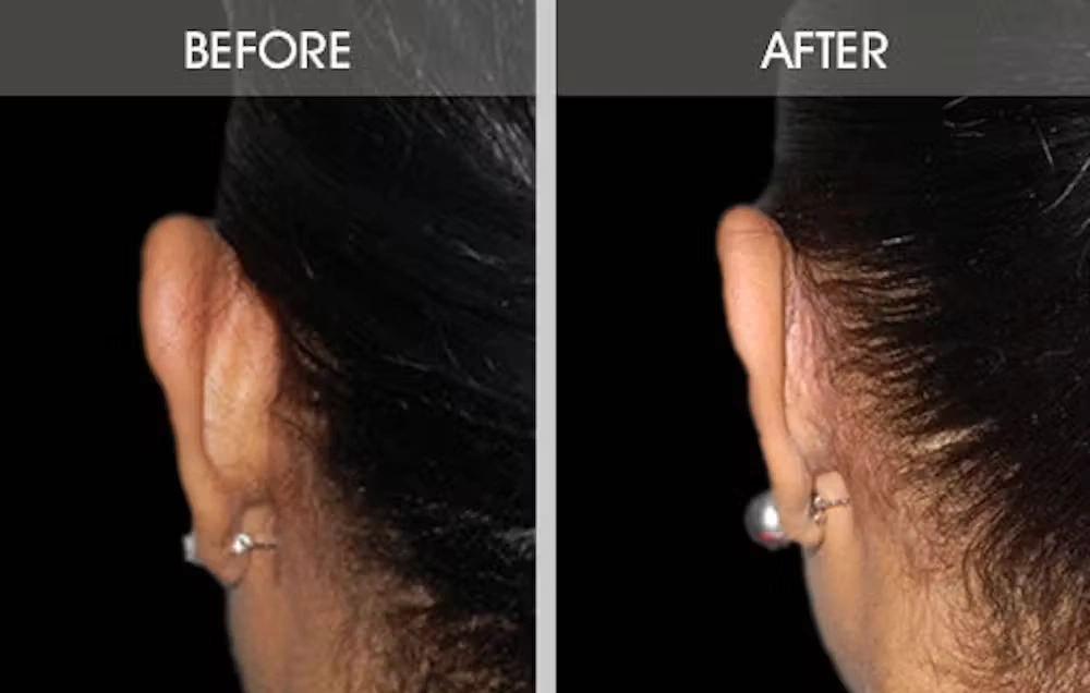 Real patient results in New York, NY Performed by Darrick E. Antell MD, FACS