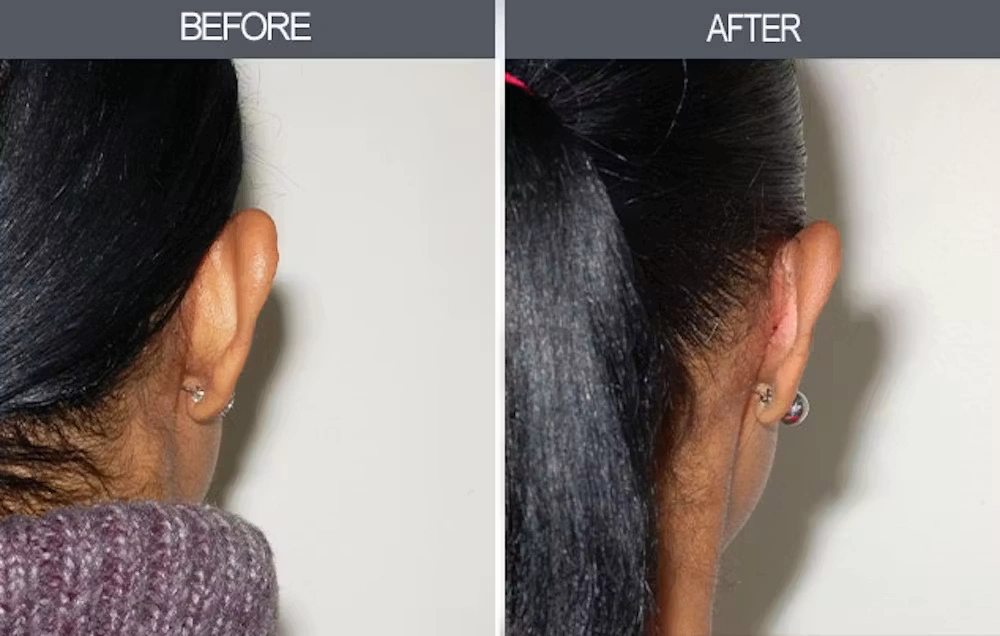 Real patient results in New York, NY Performed by Darrick E. Antell MD, FACS