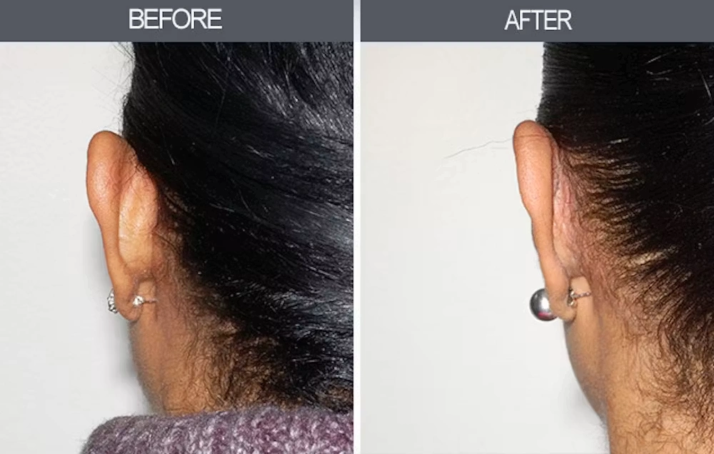 Real patient results in New York, NY Performed by Darrick E. Antell MD, FACS